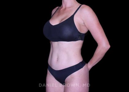 Tummy Tuck Before & After Patient #11050