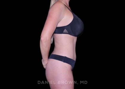Tummy Tuck Before & After Patient #11050