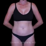 Tummy Tuck Before & After Patient #11050