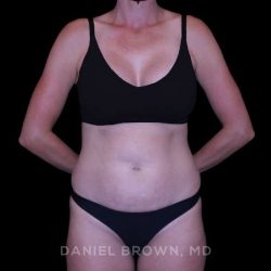 Tummy Tuck Before & After Patient #11050