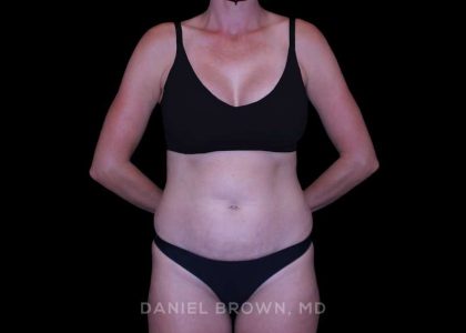 Tummy Tuck Before & After Patient #11050