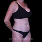 Tummy Tuck Before & After Patient #11050