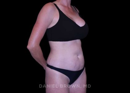 Tummy Tuck Before & After Patient #11050