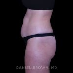 Tummy Tuck Before & After Patient #11050