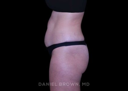 Tummy Tuck Before & After Patient #11050