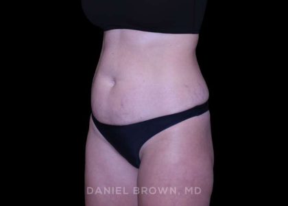 Tummy Tuck Before & After Patient #11050