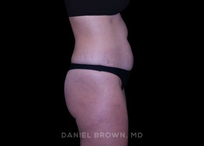 Tummy Tuck Before & After Patient #11050