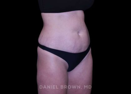 Tummy Tuck Before & After Patient #11050