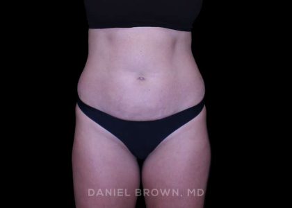 Tummy Tuck Before & After Patient #11050