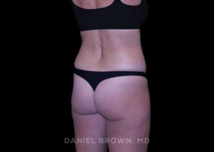 Tummy Tuck Before & After Patient #11050