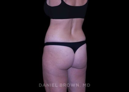 Tummy Tuck Before & After Patient #11050