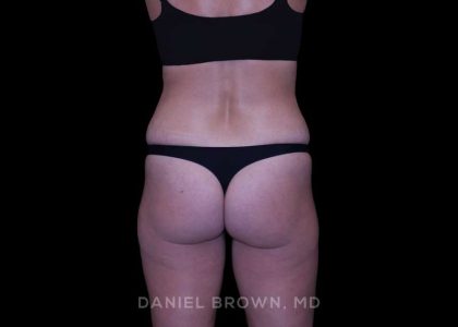 Tummy Tuck Before & After Patient #11050