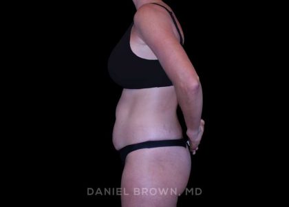 Tummy Tuck Before & After Patient #11050