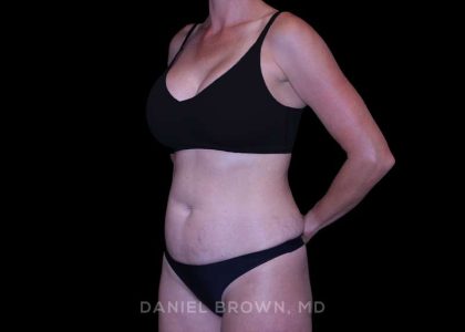 Tummy Tuck Before & After Patient #11050