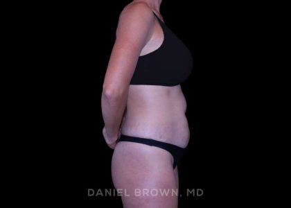 Tummy Tuck Before & After Patient #11050