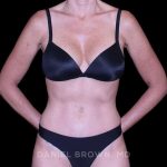 Tummy Tuck Before & After Patient #11071