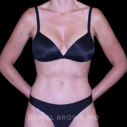 Tummy Tuck Before & After Patient #11071