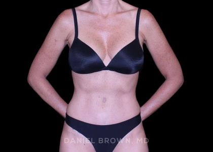 Tummy Tuck Before & After Patient #11071