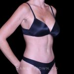 Tummy Tuck Before & After Patient #11071
