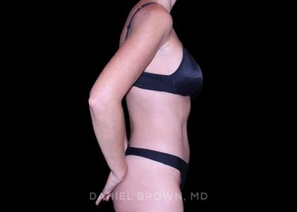 Tummy Tuck Before & After Patient #11071