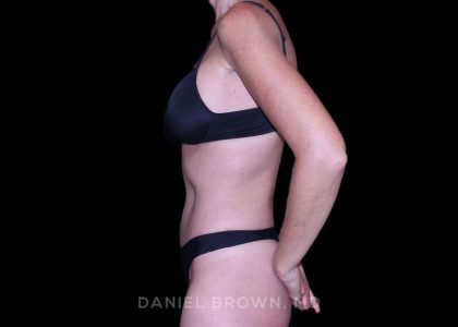 Tummy Tuck Before & After Patient #11071