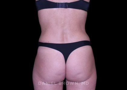 Tummy Tuck Before & After Patient #11071