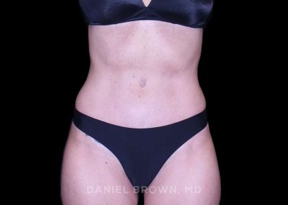 Tummy Tuck Before & After Patient #11071