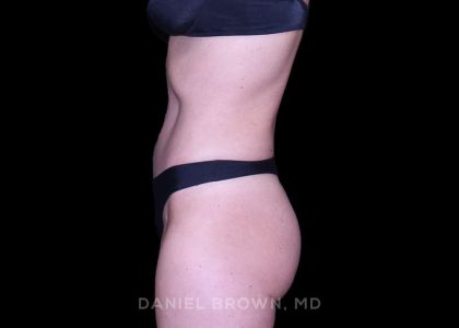 Tummy Tuck Before & After Patient #11071