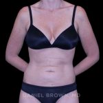 Tummy Tuck Before & After Patient #11071