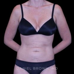 Tummy Tuck Before & After Patient #11071