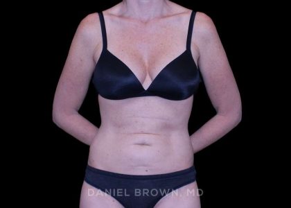 Tummy Tuck Before & After Patient #11071