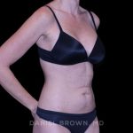 Tummy Tuck Before & After Patient #11071