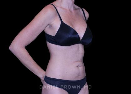 Tummy Tuck Before & After Patient #11071