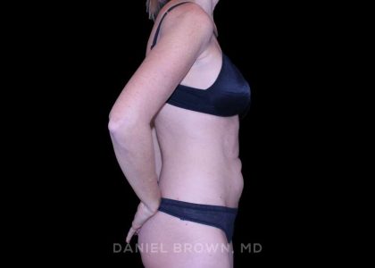 Tummy Tuck Before & After Patient #11071