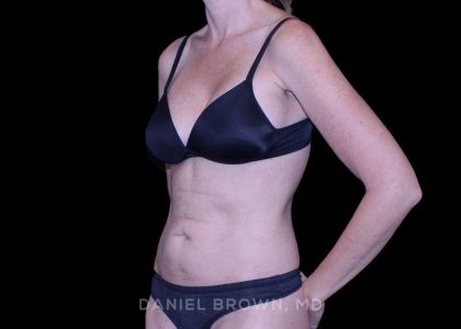 Tummy Tuck Before & After Patient #11071