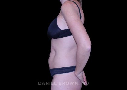 Tummy Tuck Before & After Patient #11071