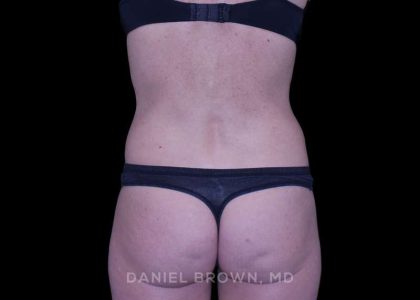 Tummy Tuck Before & After Patient #11071