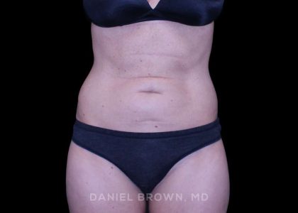 Tummy Tuck Before & After Patient #11071