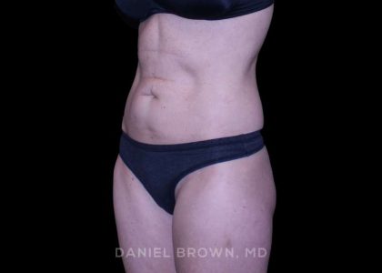 Tummy Tuck Before & After Patient #11071
