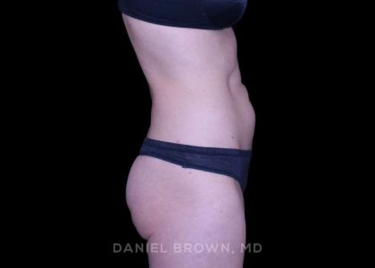 Tummy Tuck Before & After Patient #11071