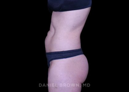 Tummy Tuck Before & After Patient #11071