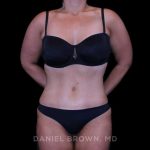 Tummy Tuck Before & After Patient #11094
