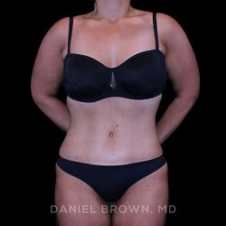 Tummy Tuck Before & After Patient #11094