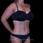 Tummy Tuck Before & After Patient #11094