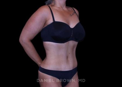 Tummy Tuck Before & After Patient #11094