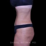 Tummy Tuck Before & After Patient #11094
