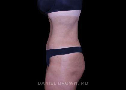 Tummy Tuck Before & After Patient #11094