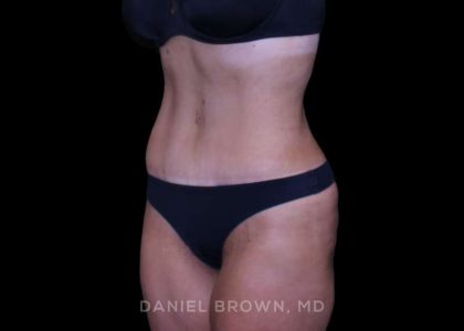 Tummy Tuck Before & After Patient #11094