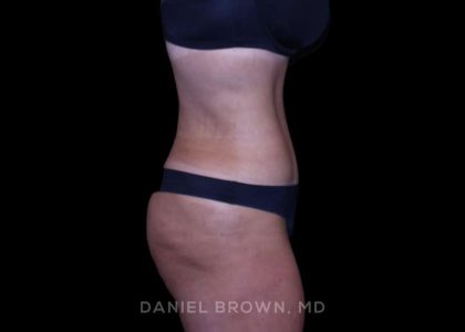 Tummy Tuck Before & After Patient #11094