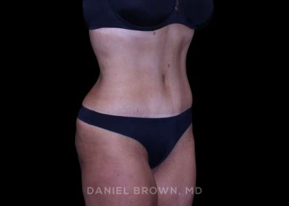Tummy Tuck Before & After Patient #11094